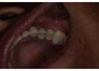 Dental crowns in Tijuana