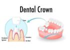 Restore Your Smile with Durable Dental Crowns