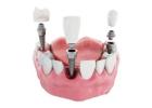 Get All-on-4 Dental Implants in Melbourne from Dr Helen’s Dental & Implant Studio