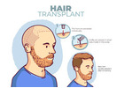 Cutibless | Best Hair Transplant Clinic in Bengaluru