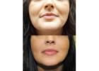 Facial Filler Treatments in Delhi