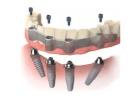 Get Dental Implants at Dr. Helen’s Dental & Implant Studio