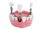 Get All-on-4 Dental Implants in Melbourne from Dr Helen’s Dental & Implant Studio