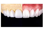 Find minimally invasive Veneers in Tijuana with ultra-thin custom-made shells