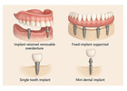 How Painful Is a Denture Implant Procedure?