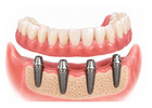 Restore Your Smile with Denture Implants in Portland