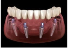 All on 4 dental implants tijuana Mexico